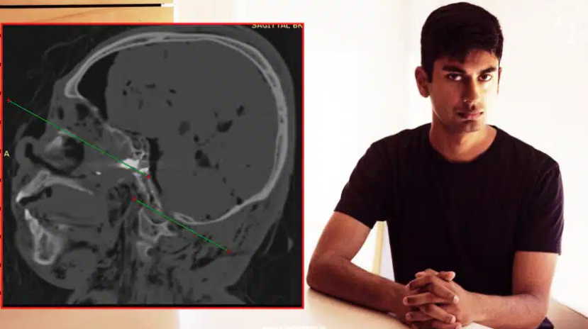 La familia del filtrador de OpenAI muestra pruebas de dos balas en el cráneo y nuevo informe toxicológico: «Fue drogado y asesinado»